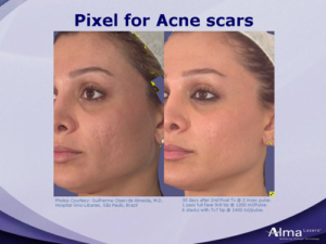 Acne Scars after treatment with the Pixel laser.