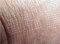 Pixel Dots Laser skin resurfacing pixel dots