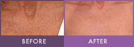 Fractional Laser Resurfacing on Chest Chest laser resurfacing