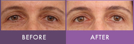Fractional Laser Resurfacing on Eyes Skin resurfacing around eyes