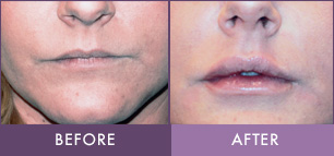 Before and After Juvederm Juvederm Lip Augmentation