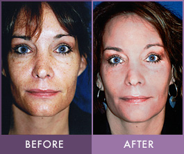 Before and After Obagi NuDerm Before and after Obagi NuDerm treatment
