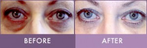 Before & After Restylane tear trough augmentation