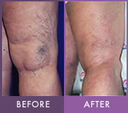 Before and After Sclerotherapy Sclerotherapy before and after