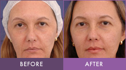 Before and After Facial skin resurfacing