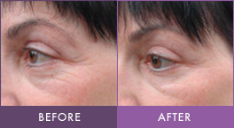 Before and After Accent Thermotherapy Accent thermotherapy