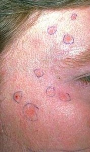 Freckles Vs Sun Spots - Doctor answers on HealthTap