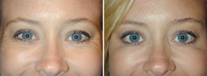 Botox eyes