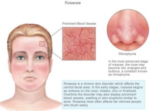 laser treatments for rosasea