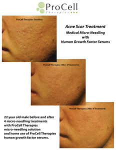 MicroNeedling & Acne Scars