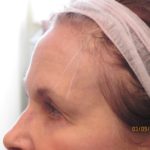  Before Brow Lift