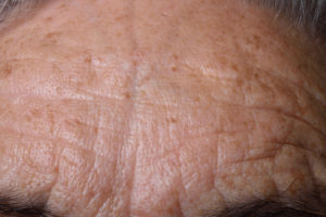 Age spot pic