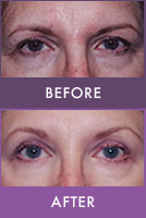 Before and After Botox