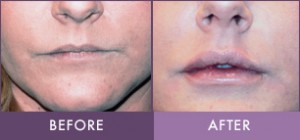 Before and After Dermal Filler