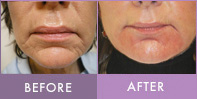 Before and After Radiesse Chin Augmentation chin lift