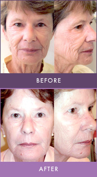 Sculptra mini face lift