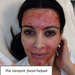  Kim Kardashian's Vampire Facial